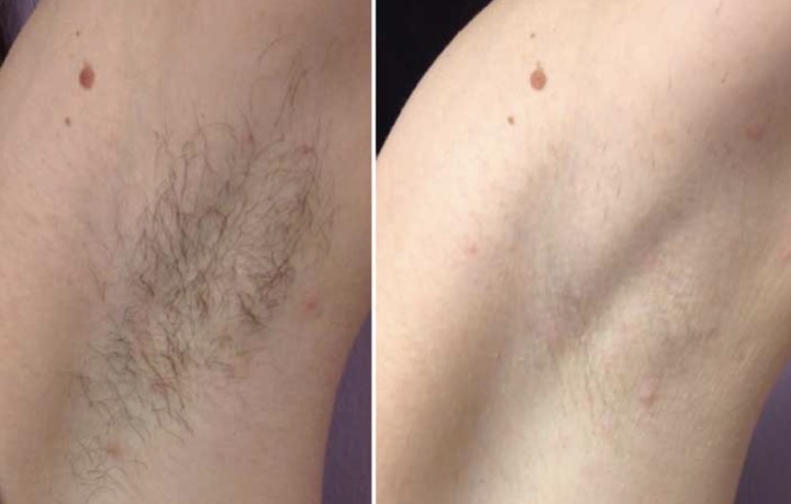 Avant apres epilation laser - Aisselles