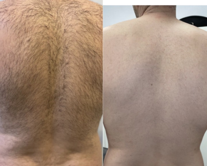 Avant apres epilation laser - Dos