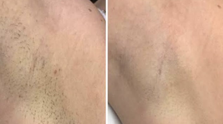 Avant apres epilation laser - Aisselles