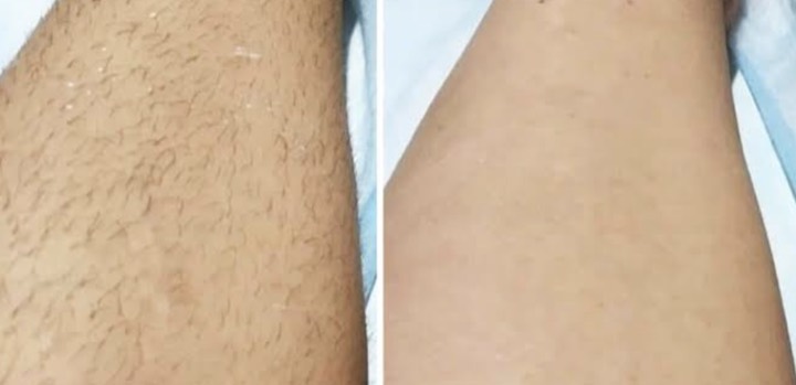 Avant apres epilation laser - Jambe